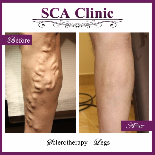 Sclerotherapy - Legs